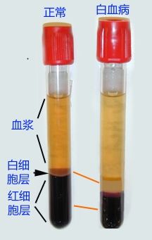 科普一下到底什么叫做白血病