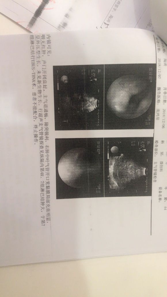 我父亲刚确诊了小细胞肺癌晚期肝淋巴骨转移