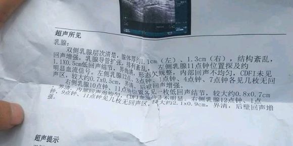 大家看下图片，是乳腺癌么