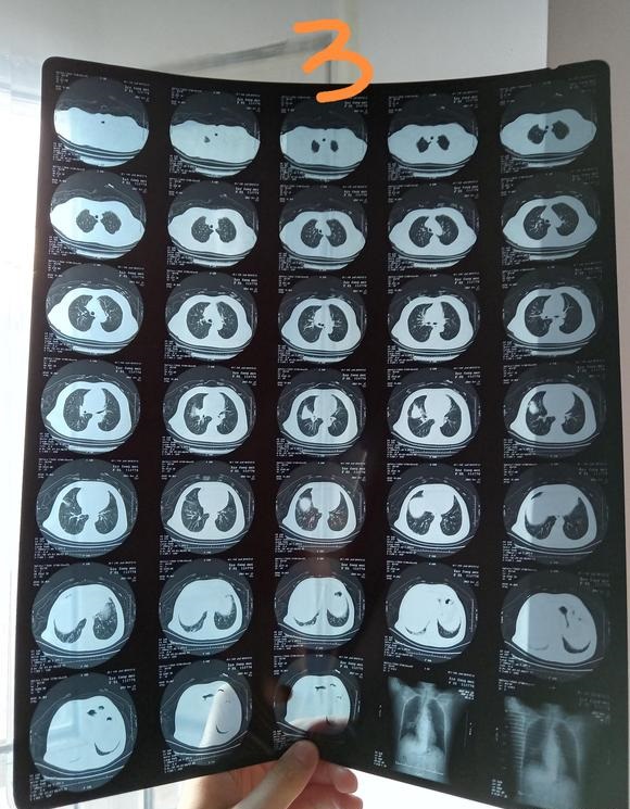 医生说姥姥可能是肺癌麻烦大家帮忙看一下万分感谢