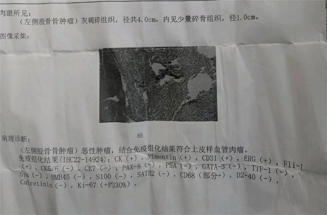 股骨肿瘤，病理是恶性肿瘤，上皮样血管肉瘤