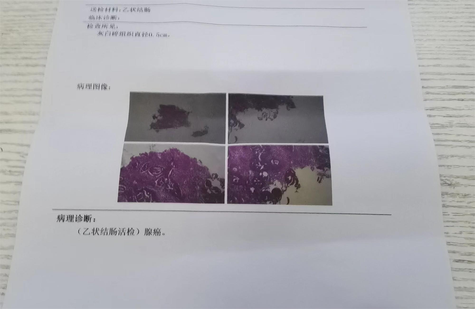 病理检查就写了一句话这是严重吗