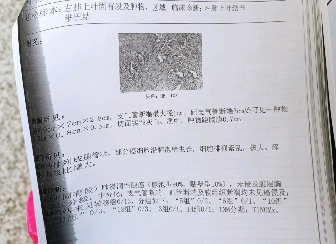 肺癌帮助看一下